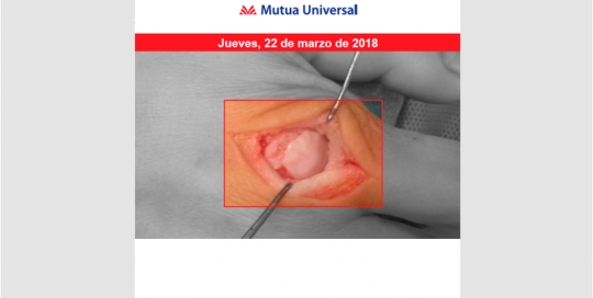Lesiones osteocondrales en la extremidad superior